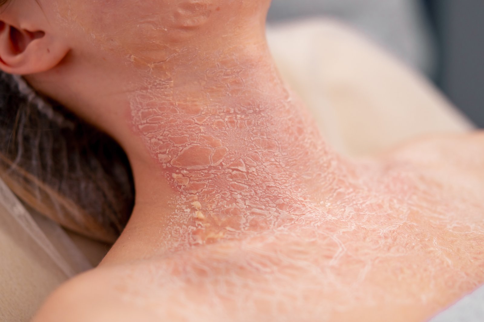 Eczema Relief Image
