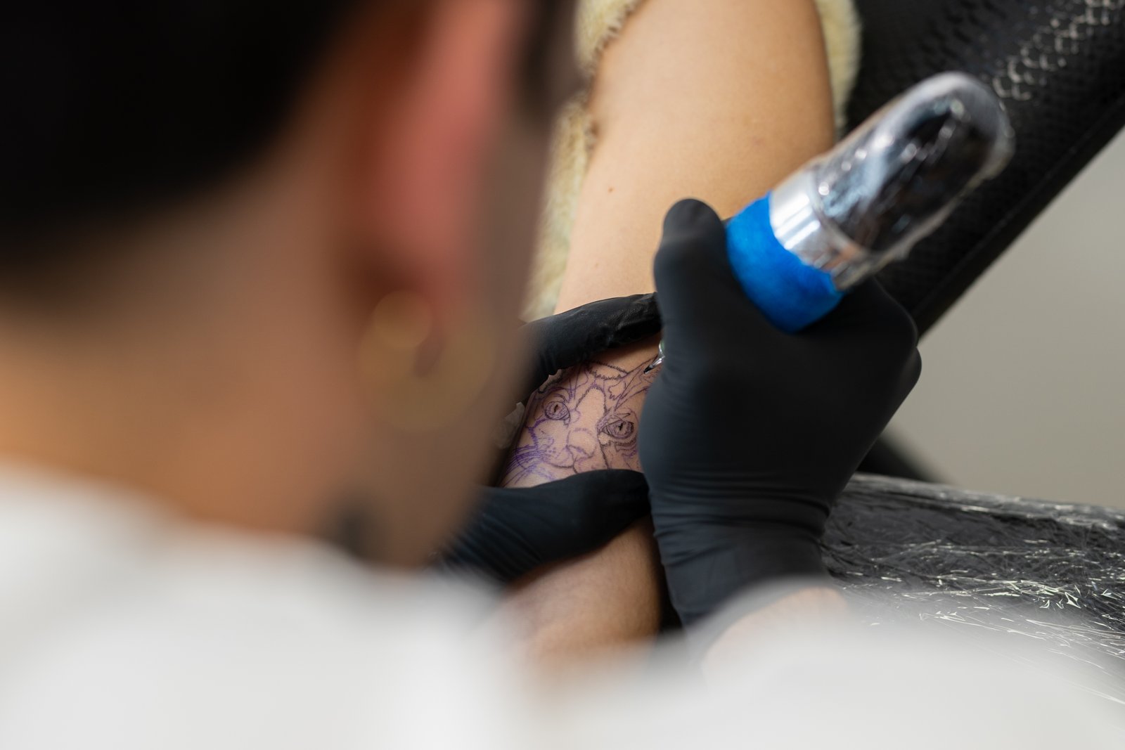 Laser tattoo removal procedure