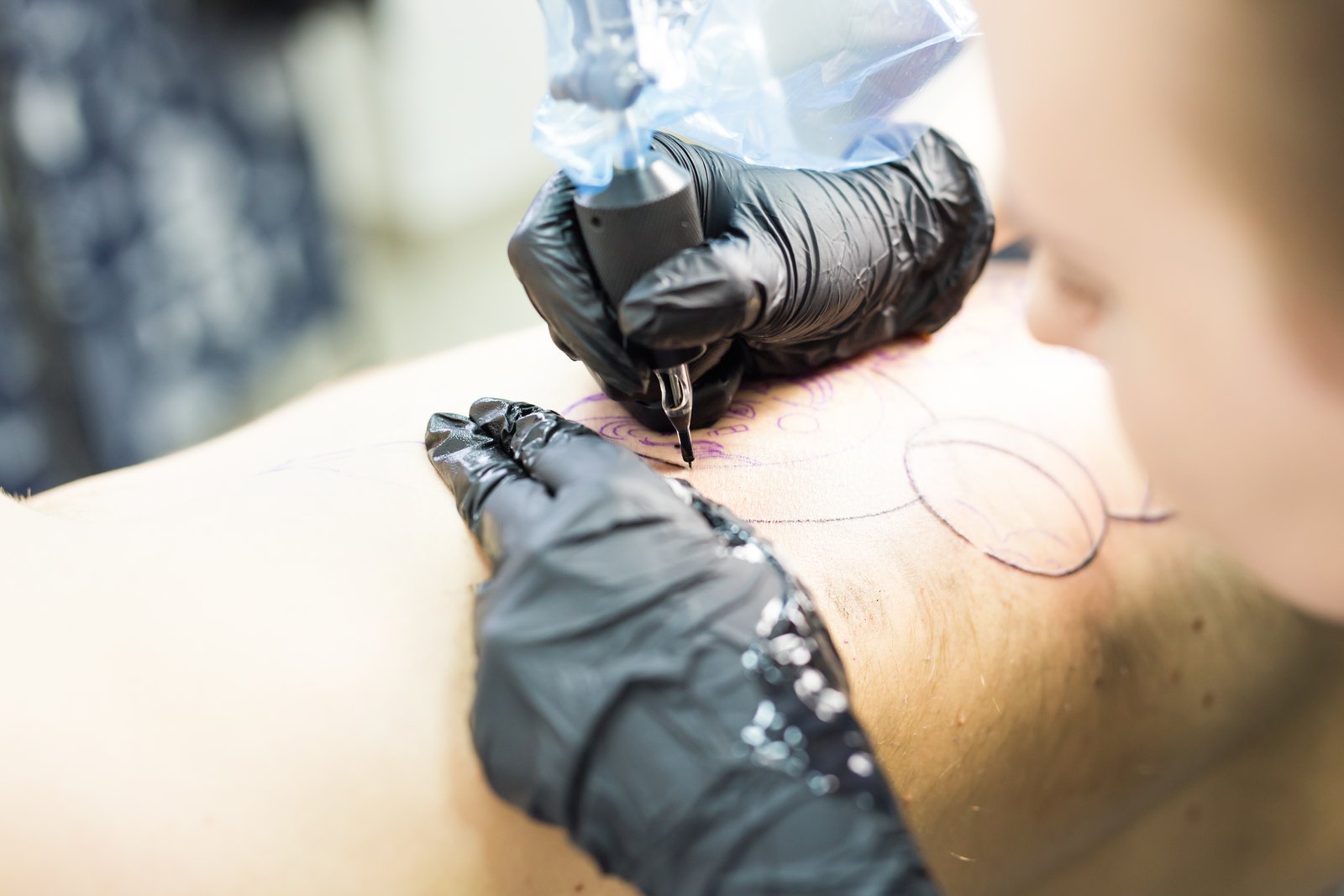 Tattoo Removal Image